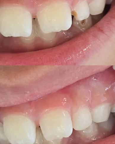 Antes e depois de restauração estética em dente anterior